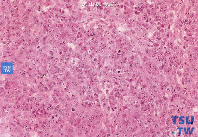 儿童肾恶性横纹肌样瘤，镜下显示瘤细胞密集排列像淋巴瘤