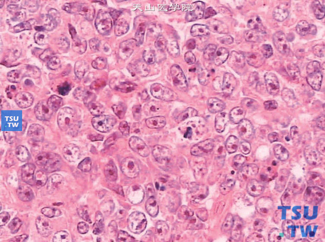 儿童肾恶性横纹肌样瘤，镜下显示瘤细胞明显的大核仁