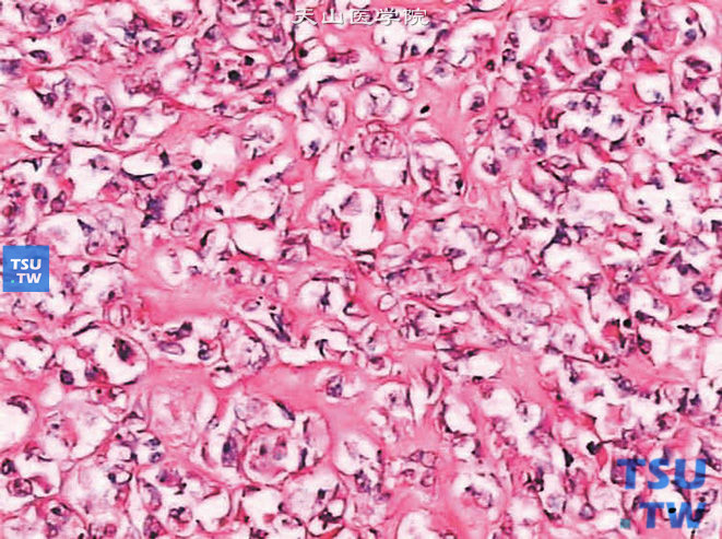 儿童肾恶性横纹肌样瘤，镜下显示瘤细胞排列呈巢状，像骨肉瘤