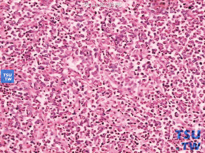 儿童肾恶性横纹肌样瘤，镜下显示瘤细胞排列呈腺泡状，像横纹肌肉瘤