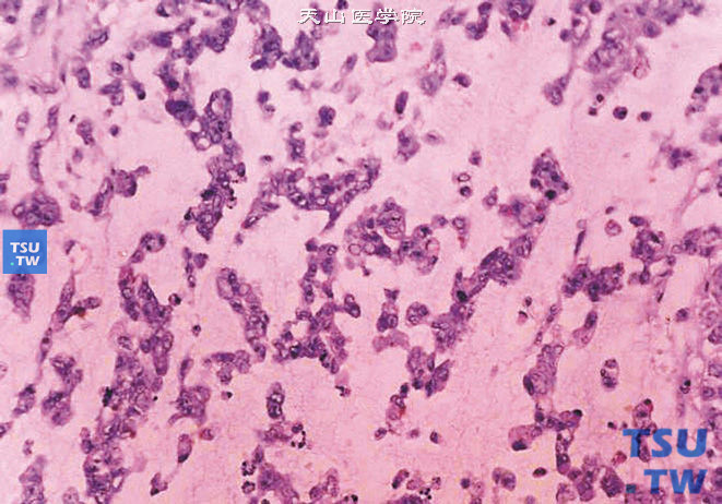 儿童肾恶性横纹肌样瘤，镜下显示瘤细胞排列呈索状