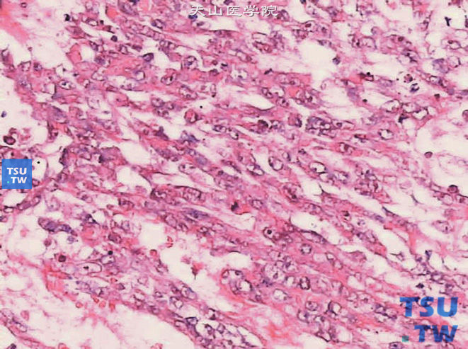 儿童肾恶性横纹肌样瘤，镜下显示瘤细胞呈梭形
