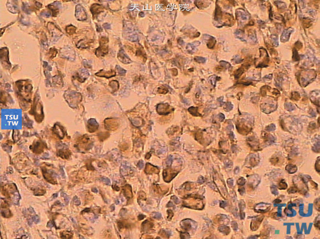 儿童肾恶性横纹肌样瘤，免疫组化显示瘤细胞NSE阳性