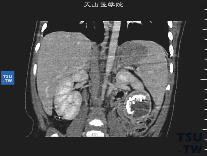 儿童骨化性肾肿瘤，CT显示左肾片状密度增高钙化影