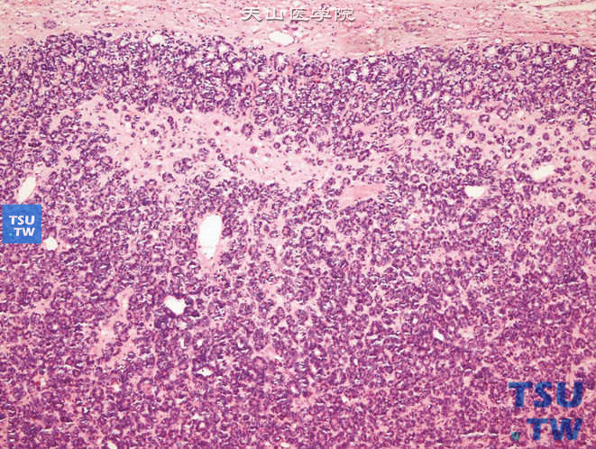 儿童后肾腺瘤，镜下显示密集的大小不一的肾小管结构、被无细胞间质分割