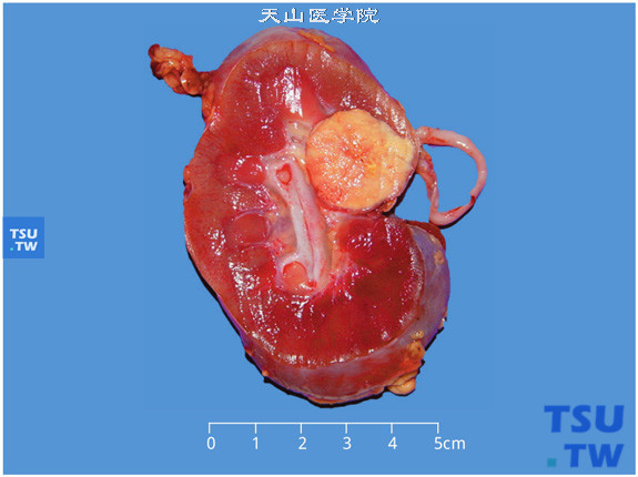儿童肾细胞癌，剖面显示近肾门和肾盂处一圆形肿物