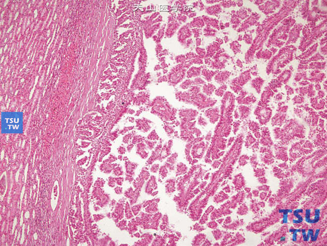 儿童肾细胞癌，镜下显示乳头状肾细胞癌，癌细胞排列呈乳头状