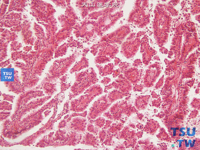 儿童肾细胞癌，上图放大，显示嗜酸性胞质
