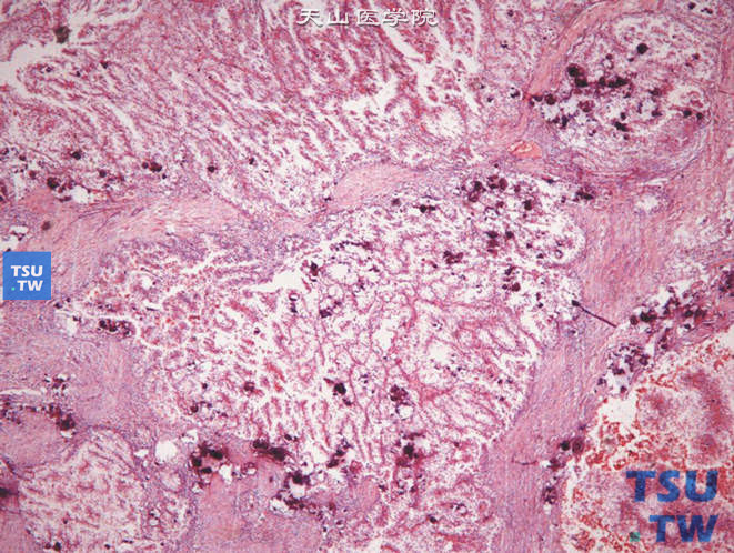 儿童79Xp11.2易位TFE基因融合性肾癌，镜下显示纤维组织分割、大量砂粒体样钙化、乳头状肿物