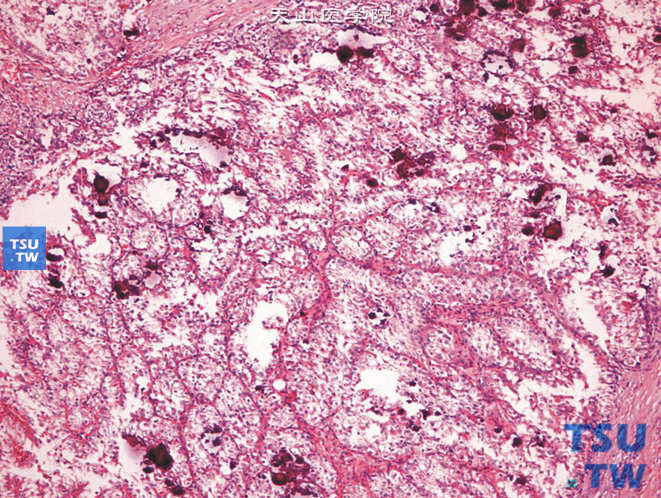 儿童Xp11.2易位TFE基因融合性肾癌，镜下显示含大量砂粒体的乳头状肿物
