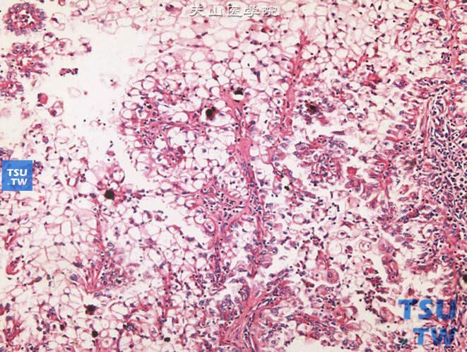 儿童81Xp11.2易位TFE基因融合性肾癌，镜下显示乳头、胞质透明、嗜酸并见砂粒体