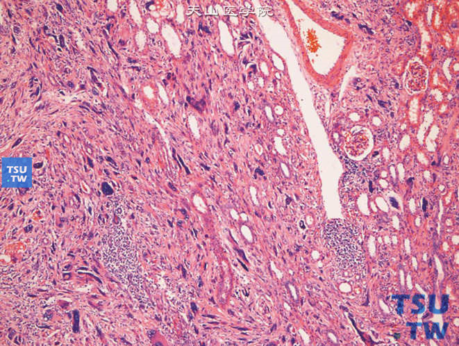 儿童肾多表型间变性肉瘤（Polyphenotypic anaplastic sarcoma of the kidney），肾实质中见大量深染、怪异的瘤巨细胞和梭形瘤细胞