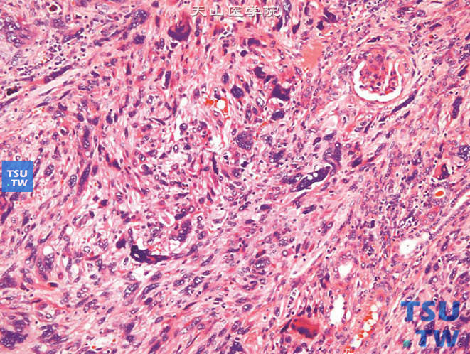 儿童肾间变性肉瘤，镜下显示大量深染、形态怪异的瘤细胞