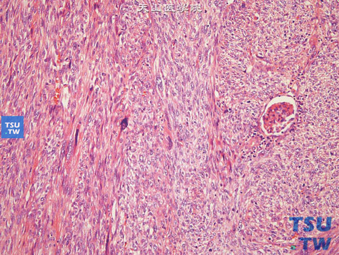 儿童肾间变性肉瘤，镜下显示大量梭形瘤细胞，呈束状排列