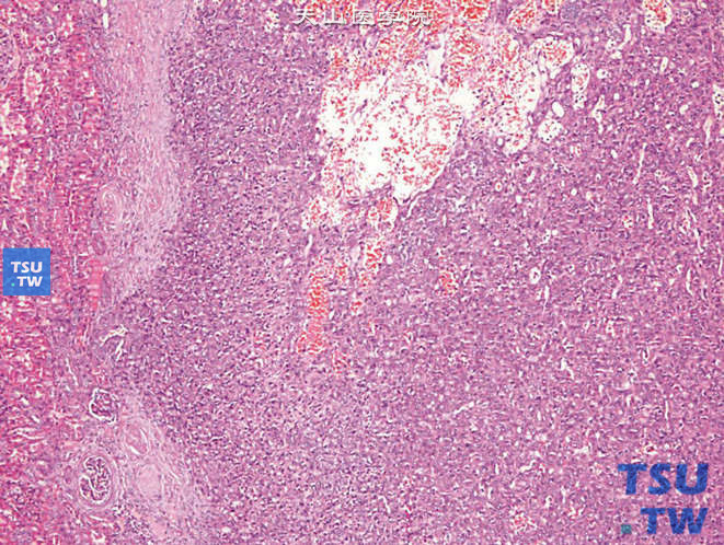 儿童肾小球旁器细胞瘤，镜下显示富于血管、片状、圆形、梭形细胞肿瘤
