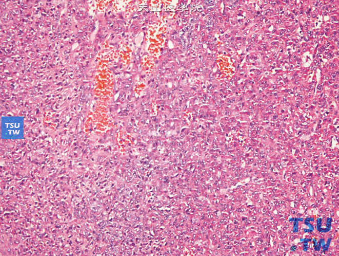 儿童肾小球旁器细胞瘤，镜下显示圆形、梭形细胞肿瘤