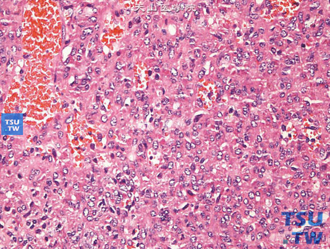 儿童肾小球旁器细胞瘤，镜下显示圆形、多角形、梭形细胞