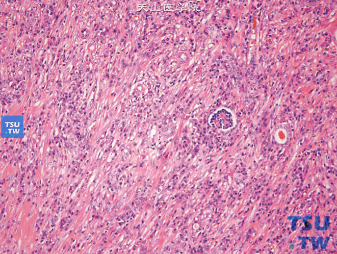 儿童肾炎性肌纤维母细胞瘤，镜下显示梭形细胞混有大量炎细胞