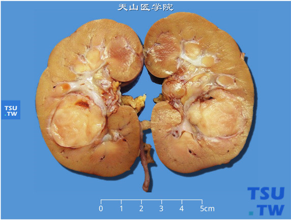 儿童肾血管周细胞瘤，肾中部见一圆形、界清的肿物