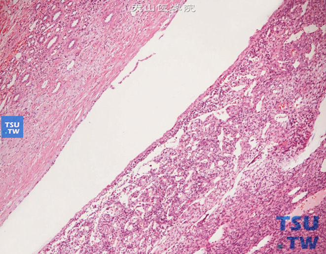 儿童肾血管周细胞瘤，显示肾盂内富于血管的梭形、圆形细胞