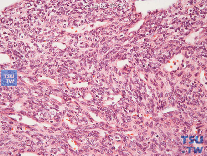 儿童肾血管周细胞瘤，显示丰富的血管及梭形、圆形细胞