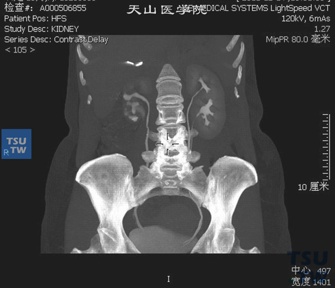 CT，双肾盂双输尿管畸形