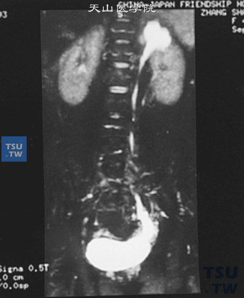左双肾盂双输尿管（核磁成像）