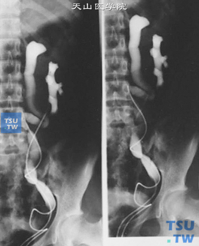 双肾盂双输尿管（逆行造影）