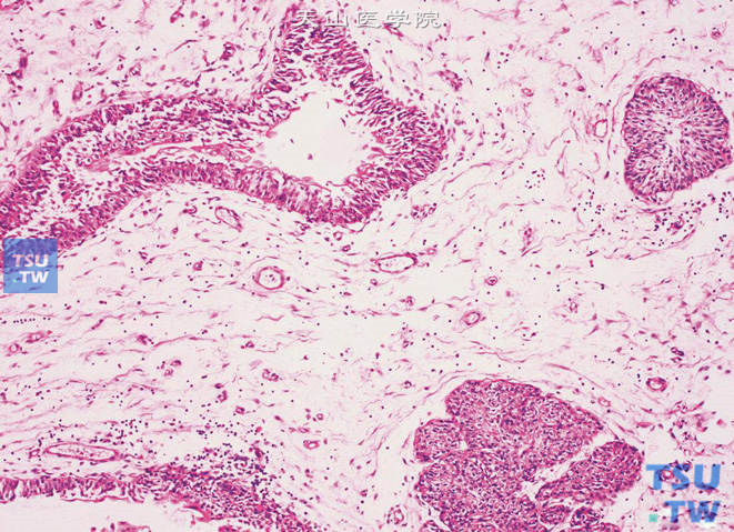 囊腺性肾盂炎，示黏膜下层形成尿路上皮巢，逐渐形成腺样或囊性结构
