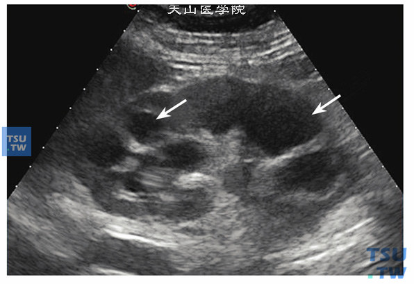 结核性肾盂炎超声图像特点：因肾结核的超声图像随病理改变而不同，病肾声像图复杂多变，但下列图像较常见，肾实质厚薄不均，大多肾上极实质破坏明显，肾内液化坏死形成的单发或多发不规则液性暗区，囊壁粗糙。肾内纤维化或钙化形成的散在强光点或光斑，多数病例合并不同程度肾积水
