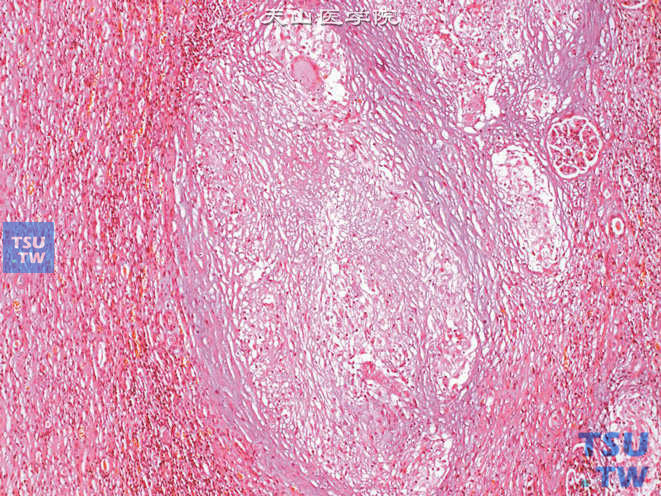 结核性肾盂炎。上图高倍，示结核结节及朗汉斯巨细胞
