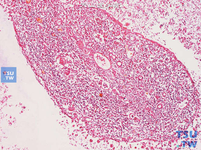  肾盂黏膜炎性息肉，被覆上皮部分脱落，间质可见大量炎细胞浸润