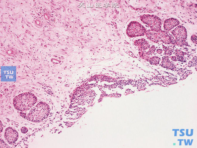  肾盂黏膜被覆上皮增生，伴Brunn巢形成。上图高倍，示Brunn巢呈界限清楚的球形实性细胞团，细胞分化好，排列规则