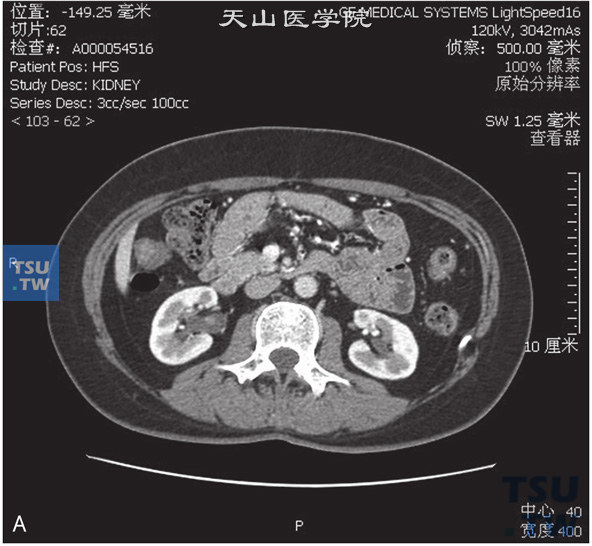 图A：CT，肾盂乳头状瘤。男，47岁，超声示肾盂内占位。右肾盂内见一结节状软组织密度灶以宽基底与前壁相连，外缘清晰，增强后可见强化
