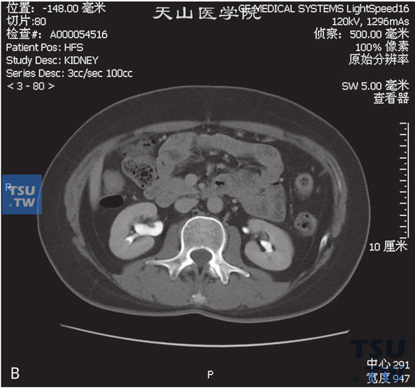 图B：CT，肾盂乳头状瘤。男，47岁，超声示肾盂内占位。右肾盂内见一结节状软组织密度灶以宽基底与前壁相连，外缘清晰，增强后可见强化