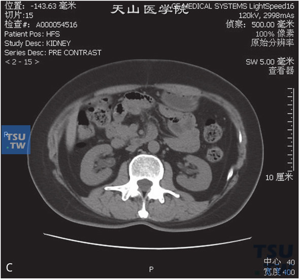 图C：CT，肾盂乳头状瘤。男，47岁，超声示肾盂内占位。右肾盂内见一结节状软组织密度灶以宽基底与前壁相连，外缘清晰，增强后可见强化