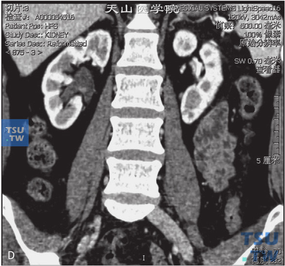 图D：CT，肾盂乳头状瘤。男，47岁，超声示肾盂内占位。右肾盂内见一结节状软组织密度灶以宽基底与前壁相连，外缘清晰，增强后可见强化