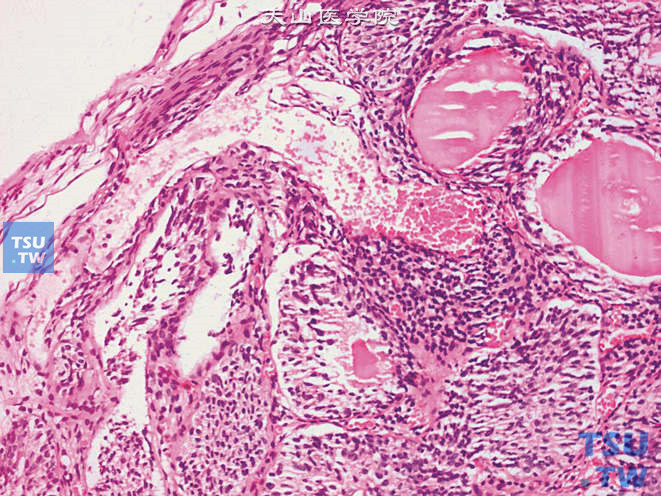 肾盂尿路上皮内翻性乳头状瘤。由致密的尿路上皮团块或条索构成