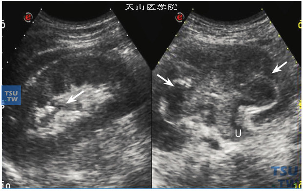 肾盂尿路上皮癌。双肾盂癌超声图像特点，左图左肾中上极肾盂内可见低回声实性肿物，（箭头指示）肿物体积小，超声易漏诊。右图右肾盂内低回声实性肿物，充满肾盂内并延续至输尿管上段，超声容易发现。肾盂肿物大多外形不规则，临床常常伴肉眼血尿
