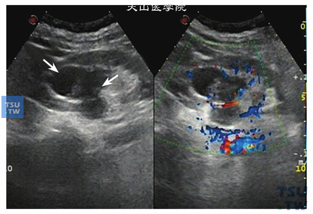 肾盂尿路上皮癌超声图像特点：肾盂肿瘤在肾盂有积水时，肿瘤在无回声的衬托下，即便很小也很容易被发现，左图左侧箭头为肾盂轻度积水的无回声区，右侧箭头是低回声肿物