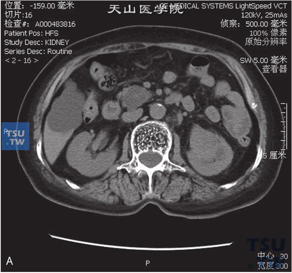 图A：CT，肾盂尿路上皮癌，男，63岁，无痛肉眼血尿2个月余。左肾盂内见软组织密度灶，累及左肾实质，左肾外形尚存在，增强后皮质期及分泌期肿瘤逐渐强化