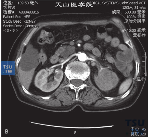 图B：CT，肾盂尿路上皮癌，男，63岁，无痛肉眼血尿2个月余。左肾盂内见软组织密度灶，累及左肾实质，左肾外形尚存在，增强后皮质期及分泌期肿瘤逐渐强化