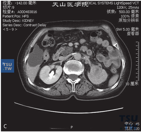 图C：CT，肾盂尿路上皮癌，男，63岁，无痛肉眼血尿2个月余。左肾盂内见软组织密度灶，累及左肾实质，左肾外形尚存在，增强后皮质期及分泌期肿瘤逐渐强化