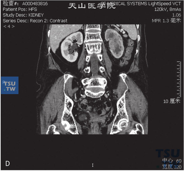 图D：CT，肾盂尿路上皮癌，男，63岁，无痛肉眼血尿2个月余。左肾盂内见软组织密度灶，累及左肾实质，左肾外形尚存在，增强后皮质期及分泌期肿瘤逐渐强化