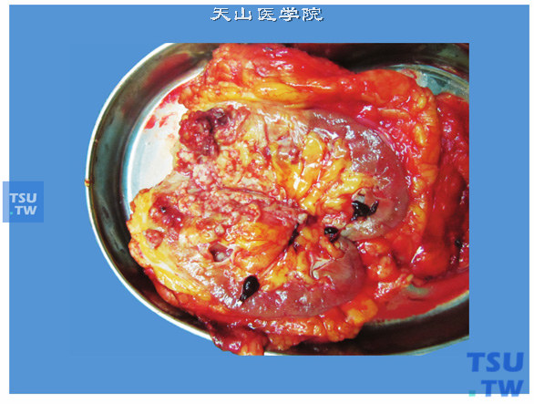 肾盂尿路上皮癌（大体）。本例瘤体较大，几乎占满整个肾盂