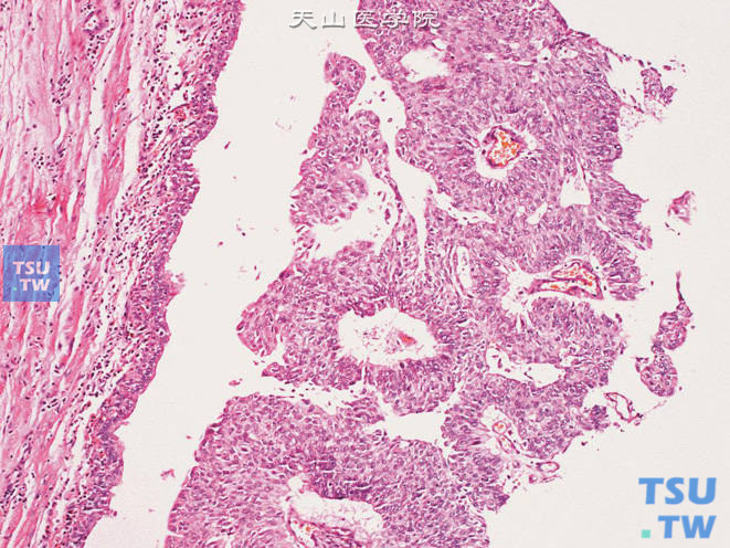 肾盂低级别乳头状尿路上皮癌。细胞异型性不明显，排列较规则，有极性
