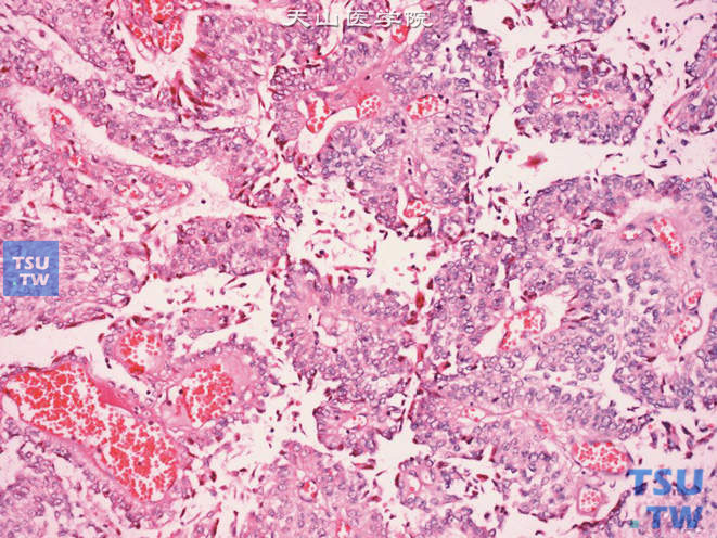 肾盂低级别尿路上皮癌，细胞大小、形态较一致，极性存在
