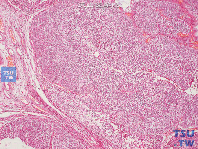 肾盂低级别尿路上皮癌，与黏膜交界处未见浸润性生长