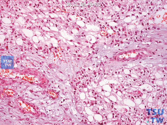 肾盂高级别浸润性尿路上皮癌，类脂细胞变异型。可见类似于印戒细胞的类脂细胞