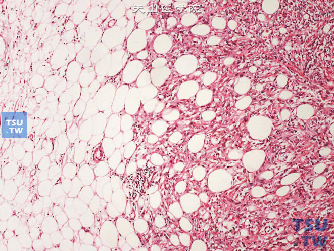 肾盂高级别浸润性尿路上皮癌，上图高倍，示细胞分化差，核分裂象易见。肿瘤侵犯肾盂周围脂肪